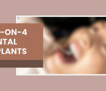 All on 4 dental implants