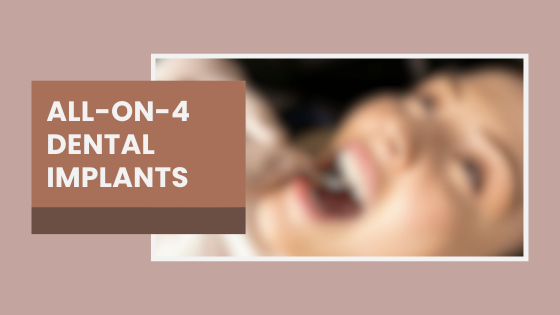 All on 4 dental implants